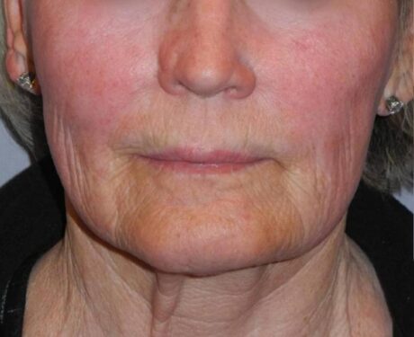 CO2 Laser Resurfacing case #4638