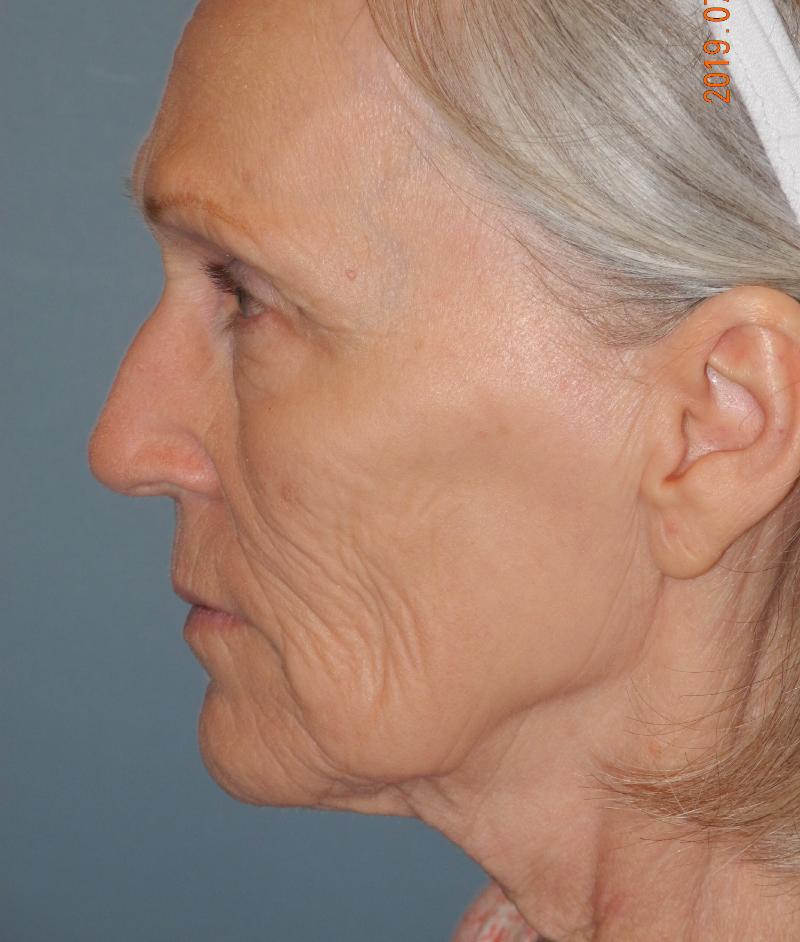 CO2 Laser Resurfacing case #4679