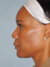 Rhinoplasty case #3693