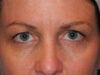 CO2 Laser Resurfacing case #4685