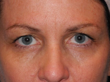 CO2 Laser Resurfacing case #4685