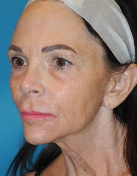 CO2 Laser Resurfacing case #4686