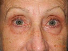 Blepharoplasty case #4764