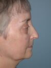 Blepharoplasty case #4858