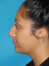 Rhinoplasty case #3519