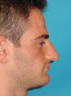 Rhinoplasty case #3520