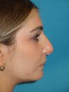 Rhinoplasty case #3521