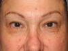 Blepharoplasty case #5141