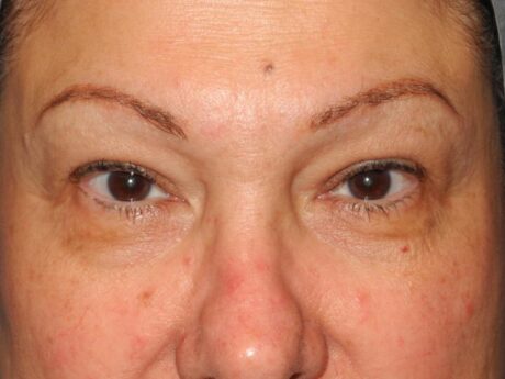 Blepharoplasty case #5141