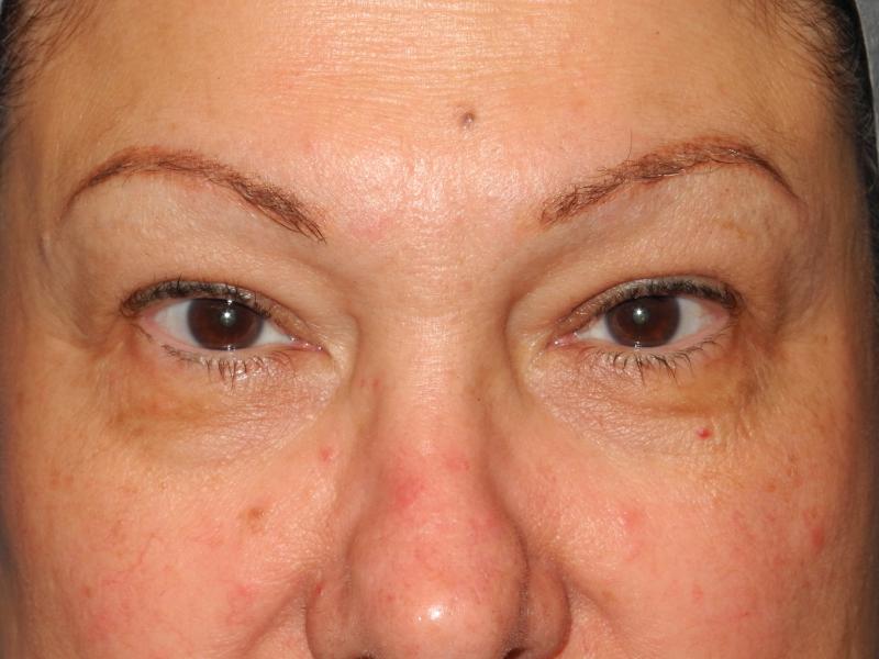 Blepharoplasty case #5141