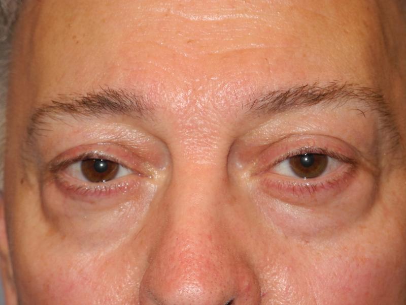 Blepharoplasty case #5148