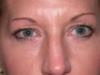 Blepharoplasty case #3924