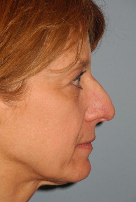 Rhinoplasty case #3522