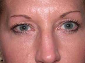 Blepharoplasty case #3924