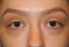 Blepharoplasty case #5197