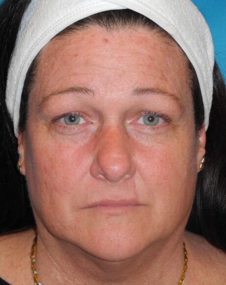 Blepharoplasty case #5225