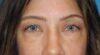 Blepharoplasty case #5246