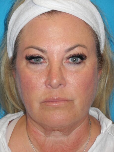 Blepharoplasty case #5252