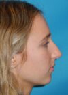 Rhinoplasty case #3523