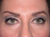 Blepharoplasty case #4043