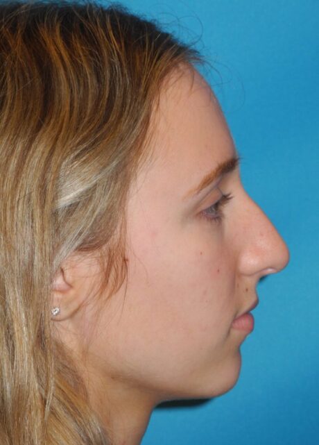 Rhinoplasty case #3523