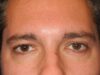 Blepharoplasty case #5270