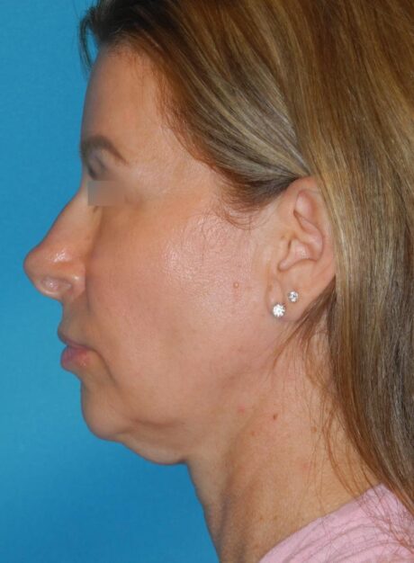 Chin Implant case #5301