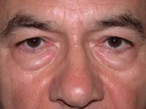 Blepharoplasty case #4046