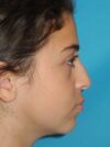 Rhinoplasty case #3525