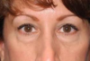 Blepharoplasty case #6471