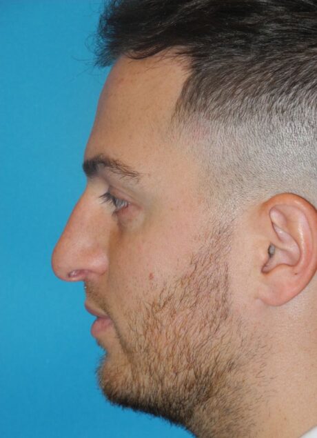 Rhinoplasty case #3526