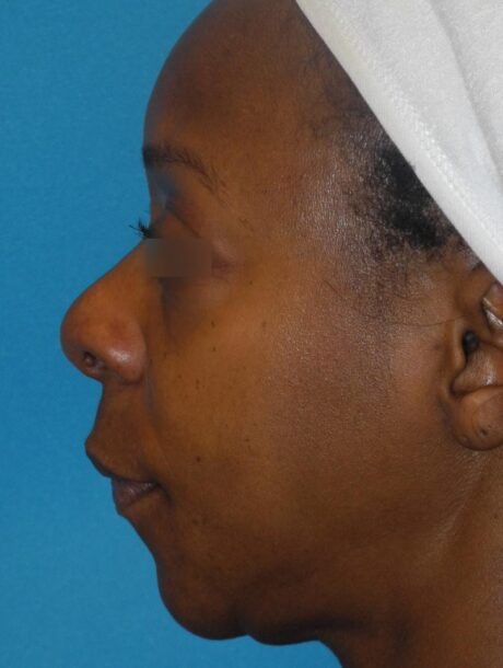 Rhinoplasty case #3527