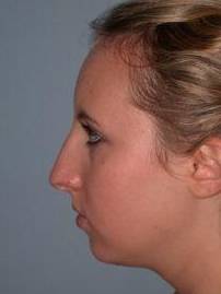 Chin Implant case #3529