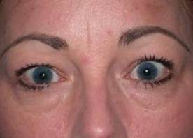 Blepharoplasty case #4075