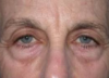 Blepharoplasty case #4080