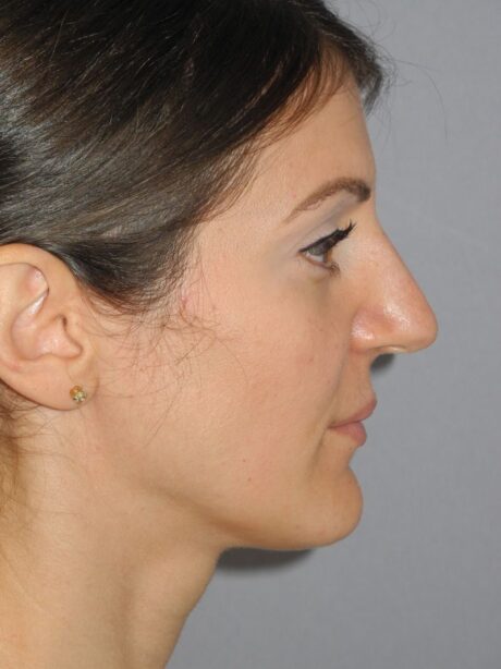 Rhinoplasty case #3680