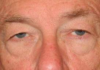 Blepharoplasty case #4117