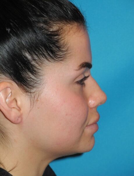 Rhinoplasty case #3681