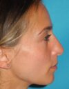 Rhinoplasty case #3682