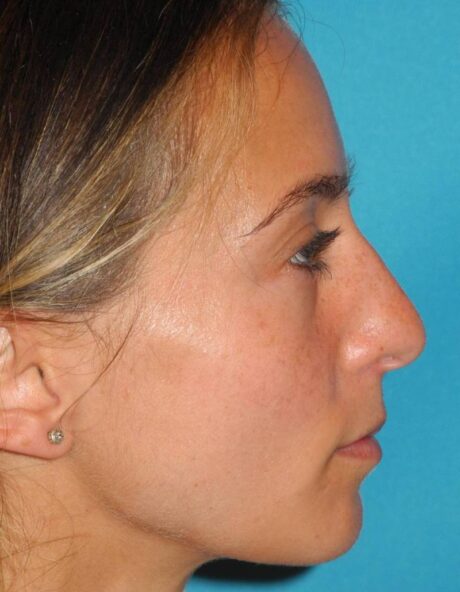 Rhinoplasty case #3682