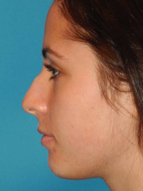 Rhinoplasty case #3683