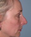 Rhinoplasty case #3684