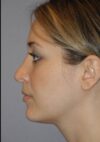 Rhinoplasty case #3685