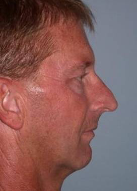 Chin Implant case #4335