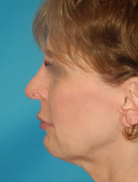 Revision Rhinoplasty case #3464