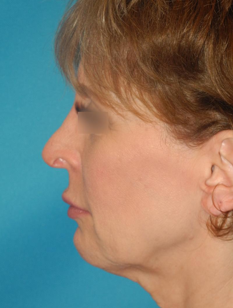 Revision Rhinoplasty case #3464