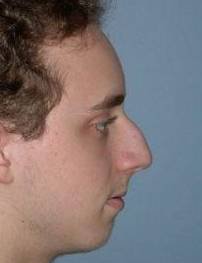 Rhinoplasty case #3512