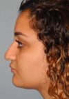 Rhinoplasty case #3687