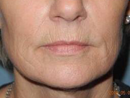 CO2 Laser Resurfacing case #4587