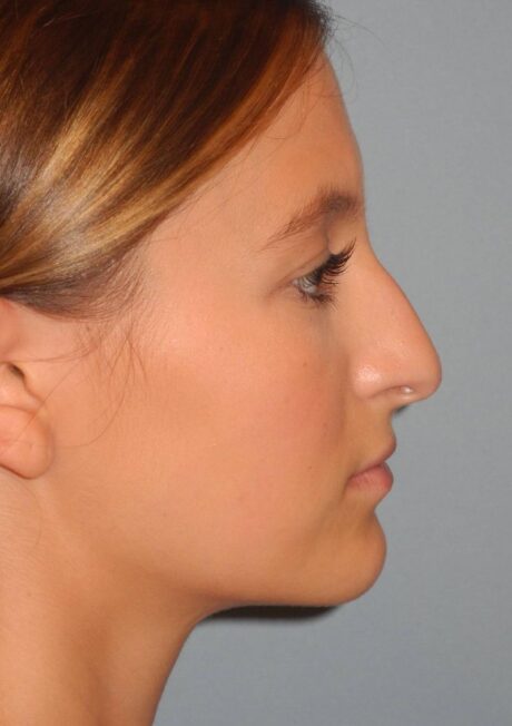 Rhinoplasty case #3688